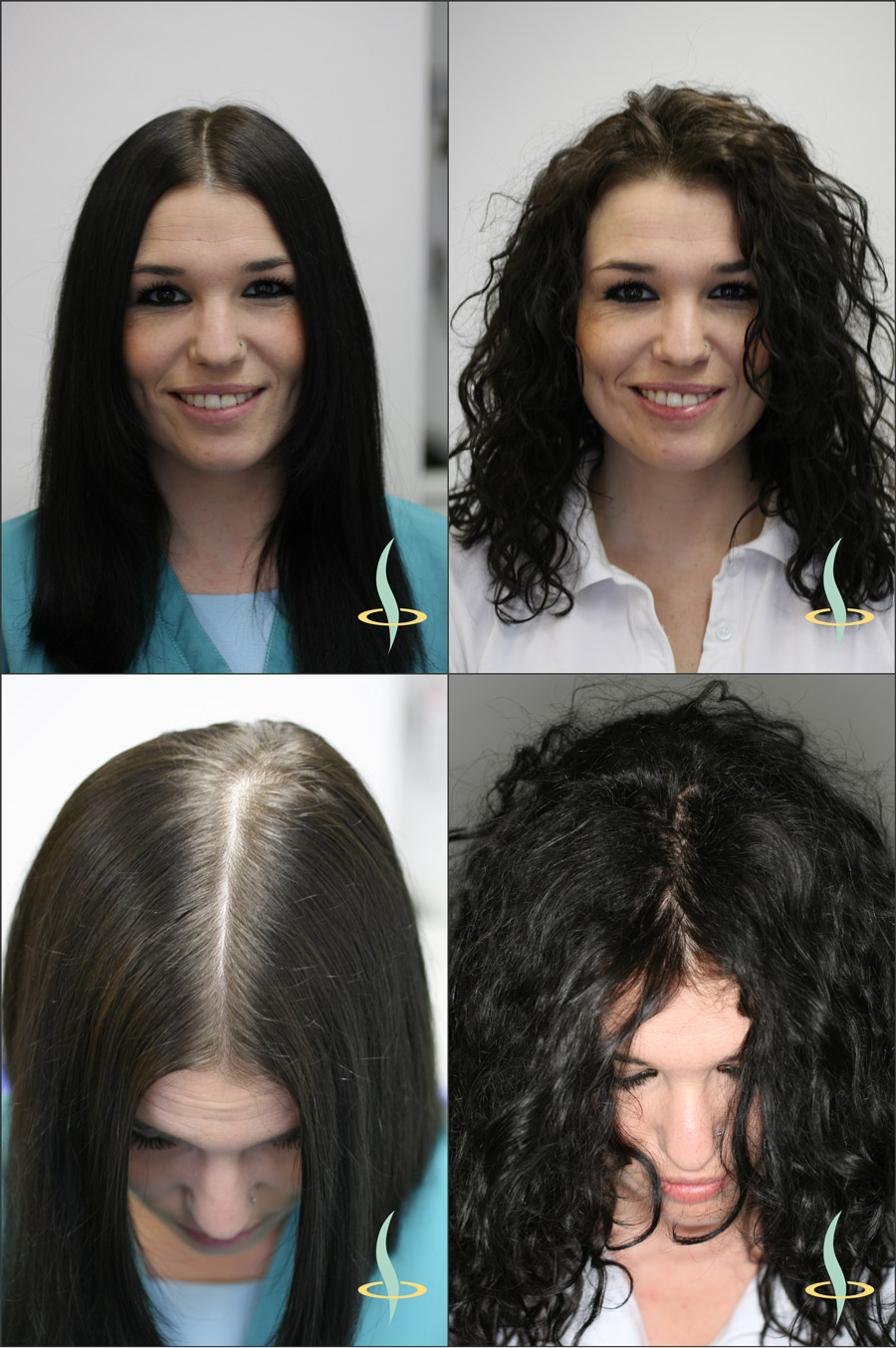 Slika 2: Optički efekat ravne (levo) i talasaste (desno) kose na vidljivost kože glave. (Izvor: grafika potiče od autora teksta)