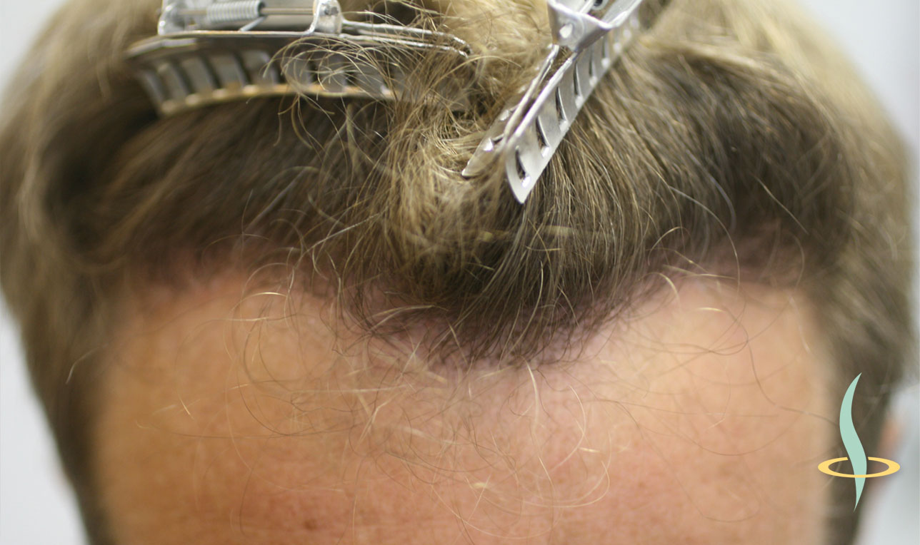 Slika 11: Početak kose nakon transplantacije sopstvene kose.