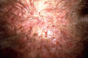 Vidljive upale i tkivo ožiljka zbog implantata veštačke kose na koži glave muškarca, snimak izbliza