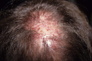 Vidljive upale i tkivo ožiljka zbog implantata veštačke kose na koži glave muškarca