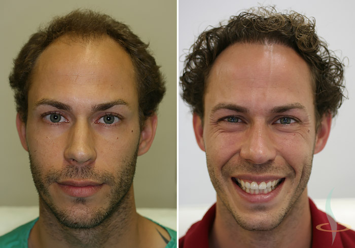 Levo: pre / desno: nakon 2. operacije