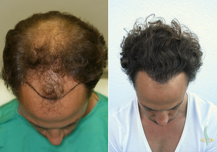 Levo: pre / desno: nakon treće operacije