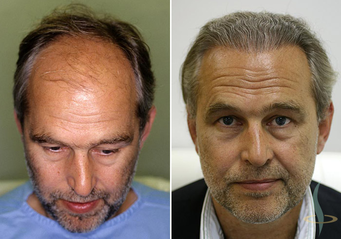 Levo: pre / desno: 8 meseci nakon treće operacije (totalno 2800 graftova)
