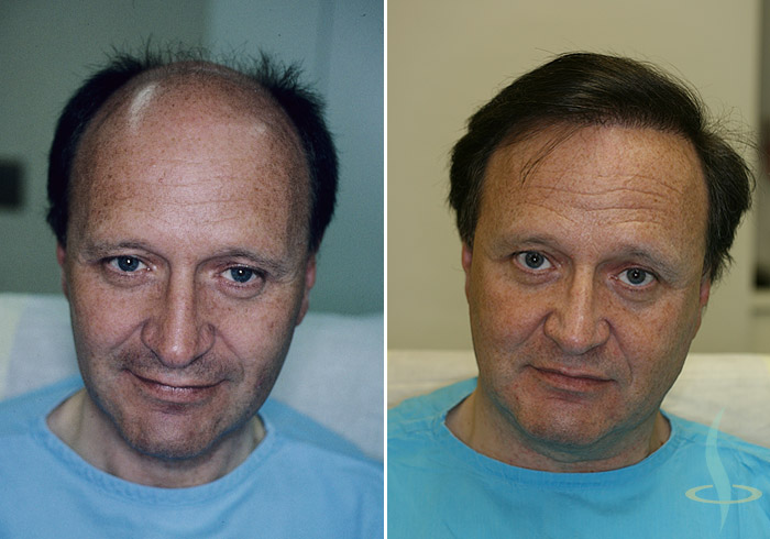 Levo: pre / desno: nakon treće operacije