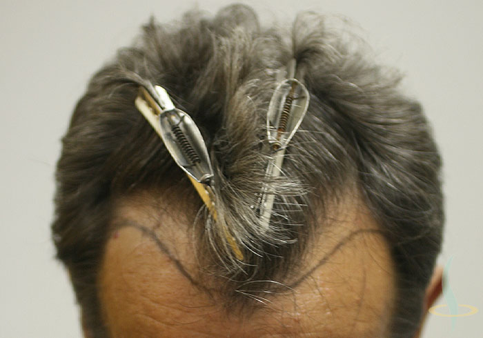 Пре операције (са линијом косе)